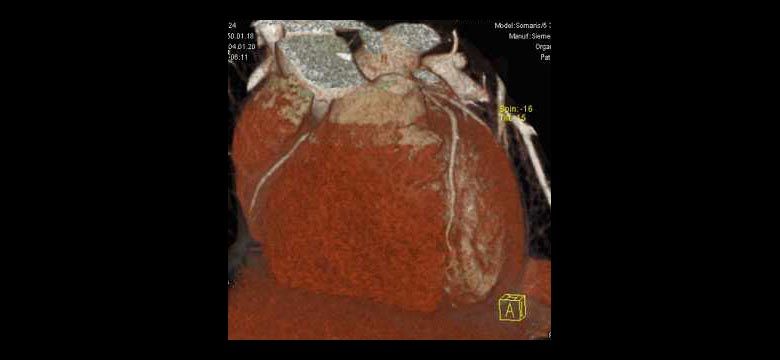Herz-CT / Coronar-CT