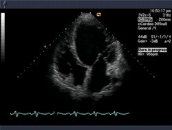 Echocardiography / TEE